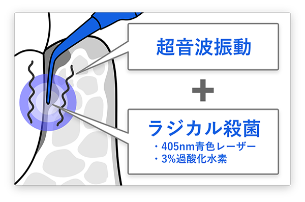 超音波振動のみ