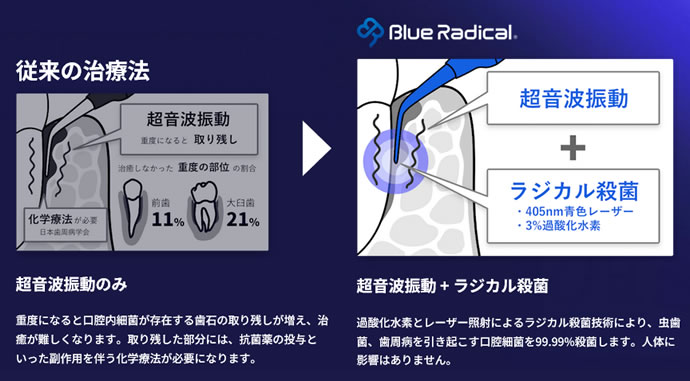 世界初の歯周病治療器「ブルーラジカルP-01」